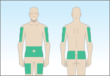 Xembify infusion sites highlighted; abdomen, thigh, upper arm, sides, back or hip.