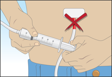 Remove and discard the needle and tubing if you see blood when pulling back on the plunger
